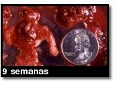 Fotografía de aborto - 9 semanas