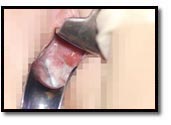 Inserción del speculum Inserción del speculum