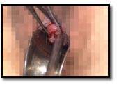 el dilatador de aborto comienza a forzar la apertura del cuello el dilatador de aborto comienza a forzar la apertura del cuello