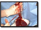 recuperación de la sangre en un recipiente después del aborto recuperación de la sangre en un recipiente después del aborto